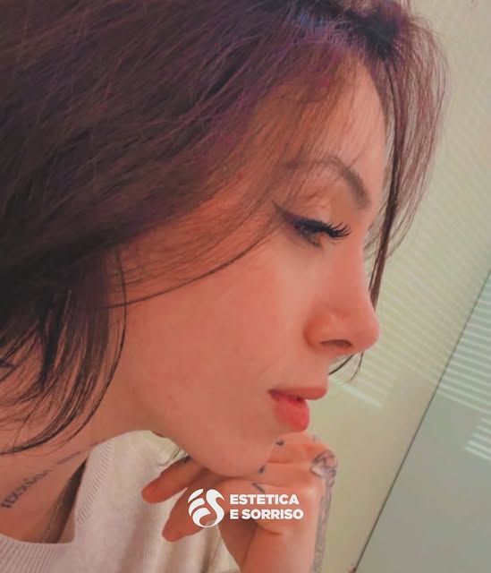 ✨ Rinoplastica – Il percorso di una nostra paziente ✨

Un risultato studiato per valorizzare il viso