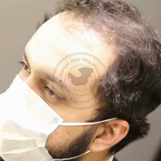 😟 बाल झड़ने की समस्या से परेशान हैं? अब समाधान पास ही है – गाजियाबाद में!
तेज़ी से झड़ते बाल, गंजाप