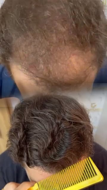 Cada transformação começa com um planejamento individualizado. ✨

Neste caso, o transplante capilar 