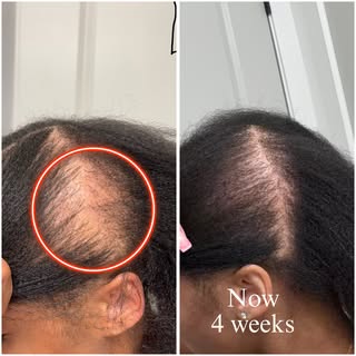4 weeks of at home treatment. Thank you to those clients that commit to them selfs and report weekly