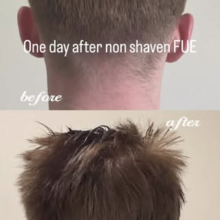 You don’t have to shave your donor or recipient area for a hair transplant! Non shave FUE is an opti