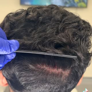 Non-shaved FUE. No funny haircuts. All discrete. 
#hair #fue #hairtransplant #hairtransplantsurgery 
