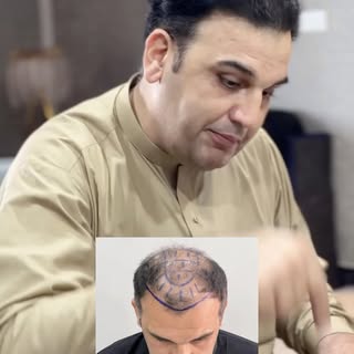 Review Time ⭐️⭐️⭐️⭐️⭐️
One Year of Micro Sapphire FUE Mega Session. 

For bookings: ISLAMABAD: 03065