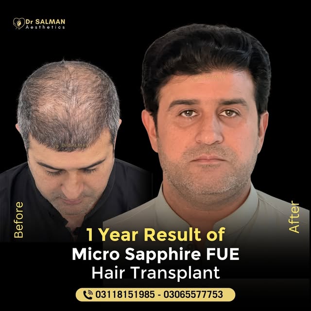 When a Man Gets His Crown Back 👑

1-Year Result of Micro Sapphire FUE by Dr. Salman Khan

The patie