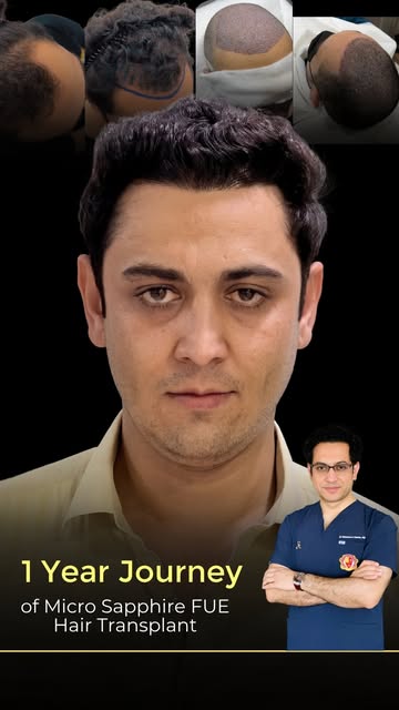 Witness the transformation of Dr. Salman’s Signature Natural Hairline Restoration with Micro Sapphir