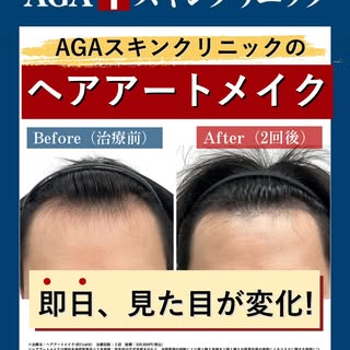 🤩ヘアアートメイクで即日ごまかす⁉️

AGA治療始めたけれど
どうしてもこの日までになんとかしたい‼️

そんな人は「ヘアアートメイク」をご案内‼️

AGA治療は継続が基本。
発毛を実感するまで