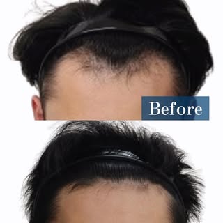 Before／Afterを公開！💡✨

「最近、薄毛が気になってきたかも…」
そう感じた今こそ、相談のタイミングです。
治療の継続がここまでの変化に繋がります。

AGAは進行性のため、早めに状態を