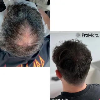 What a difference - SMP is the best way to get the most out of a hair transplant, and disguise any t