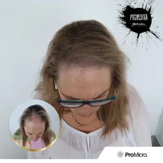 Scalp Micropigmentation has a multitude of applications not just for a shaved head. It's incredible 