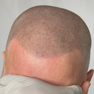 SCALP MICRO PIGMENTATION RESULTS! 

☎️(253)391-4319

✅ RESTORE YOUR HAIRLINE
✅ ADD DENSITY TO THINNI