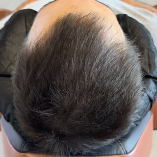 Thinning hair doesn’t have to mean shaving it all off.

Scalp Micropigmentation (SMP) density treatm