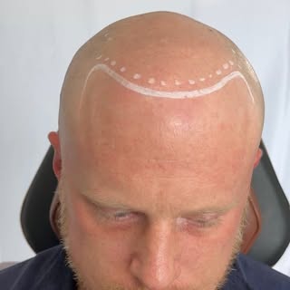 Can blondes get SMP? Absolutely. 

One of the biggest misconceptions is that scalp micropigmentation