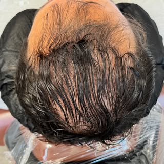 Thin hair doesn’t always mean you have to shave it. 

SMP density treatment helps reduce the contras