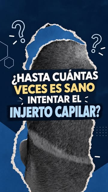 ¿Hasta cuántas veces es sano intentar un injerto capilar? 

Aunque un trasplante capilar puede reali