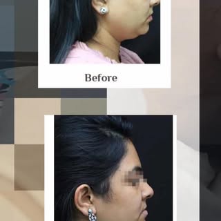 ✨ Define Your Jawline. Enhance Your Profile. ✨

Struggling with a stubborn double chin despite maint
