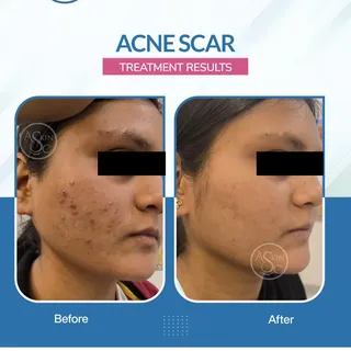✨🌿 Clearer Skin. Renewed Confidence. 🌿✨

Acne scars can linger long after acne is gone, affecting 