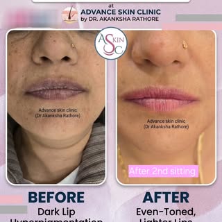 ✨ Lip Pigmentation Treatment – Healed Before & After Results ✨

See the beautiful healed results aft