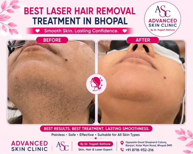 ✨ REAL BEFORE & AFTER RESULTS – LASER HAIR REMOVAL ✨

Tired of unwanted facial or body hair? 💗
Expe