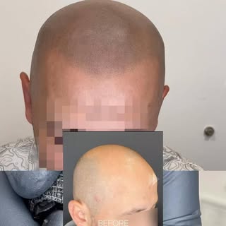 A hair loss solution for men experiencing male pattern balding. Check out these One Year Healed resu