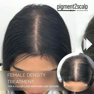 Enhance your confidence with Scalp Micropigmentation SMP! This amazing treatment creates the appeara