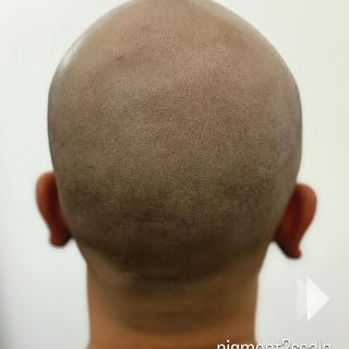 No more cul-de-sac. Just an even, natural crown.

Recover what is lost with Scalp Micropigmentation 