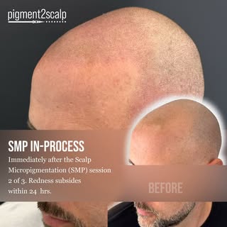 What a difference a hairline makes!

Free Video Consultations Available. 📲 

Get your questions ans