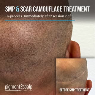 Hair transplant scars don’t have to be a permanent reminder of surgery. Scalp Micropigmentation (SMP