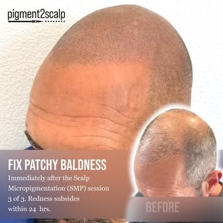 Struggling with patchy baldness or uneven hair loss? 

Scalp Micropigmentation (SMP) can create the 
