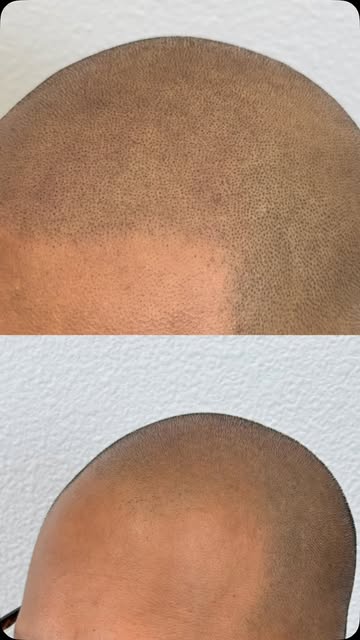 From a hairline in need of restoration to a natural, refined result.

This gentleman came to Pigment