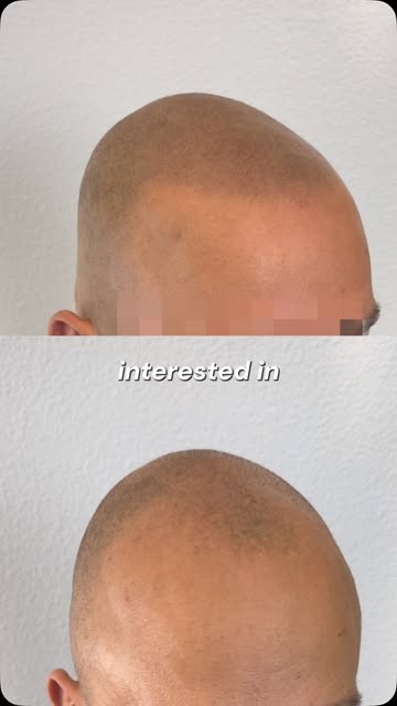 A hairline restored. Confidence restored.

Before → after 3 sessions of buzz cut SMP. His hairline h