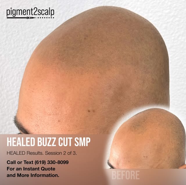 Healed. Natural. On the way to the finish line.

Session 2 of 3 with scalp micropigmentation (SMP) c