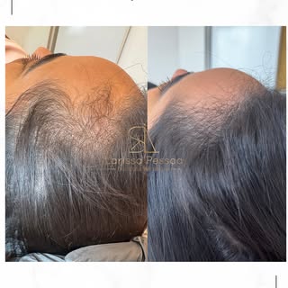 Resultados que mostram que cuidar da queda capilar faz a diferença. ✨

 #quedadecabelo #tricologista