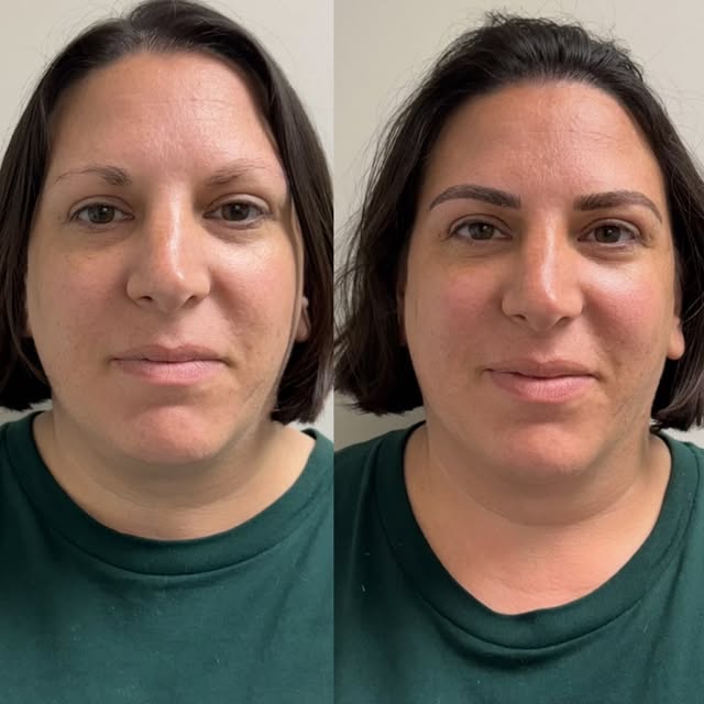 ✨ BROW TRANSFORMATION ✨

From sparse brows to beautifully defined, natural-looking brows. 🤎
Microbl
