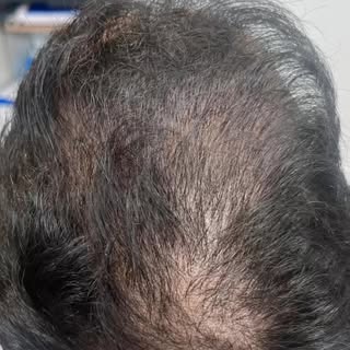 Hair Transplant - P’s Story: 

My client saw an advert on Instagram by a hair transplant clinic… adv