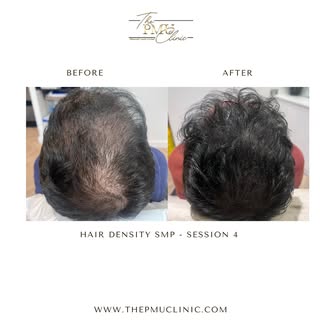 Obsessed ❤️ Hair Density SMP = Confidence. 🙌

Get the illusion of fuller hair through Scalp Micropi