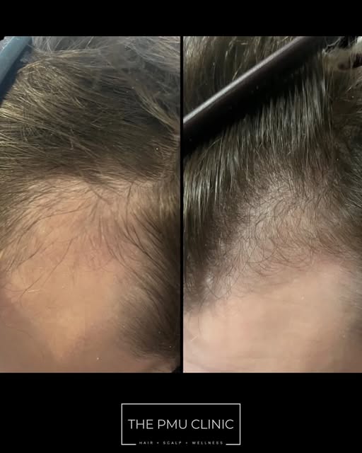 ✨ HAIR RESTORATION — BEFORE & AFTER ✨

Real results. 
Real transformation. 

How amazing is this cli