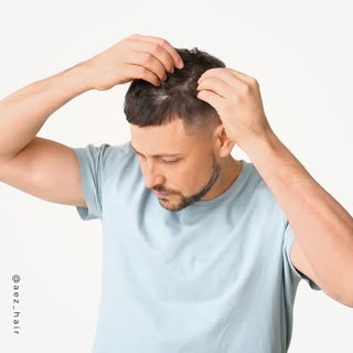 Wie lange dauert die Heilung nach einer Haartransplantation? 

Der Heilungsprozess nach einer Haartr