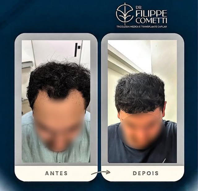 8 meses de evolução ✨

Paciente jovem com queixa de entradas frontais. Realizamos transplante capila