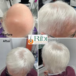 💫Before and After 

💫Medical wig installation 

Book a consultation today!

Make appointment at ri