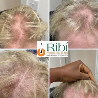 Swipe to see the After 👉

Hair replacement system for a client 

Book a consultation today to get y