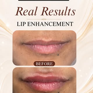 Subtle, defined and beautifully enhanced lips — with results visible immediately after the procedure