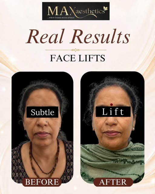 Real Results, Real Confidence✨

A refreshed, naturally lifted appearance with results of Face Lift!
