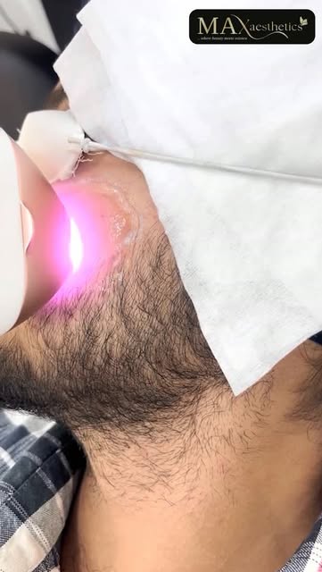 For Men Who Prefer a Cleaner, More Defined Look.

Beard Laser Hair Reduction to reduce unwanted faci