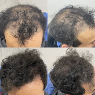 Tratamiento Capilar.

Hoy les presentamos otro de nuestros casos realizados.
Paciente con Alopecia A