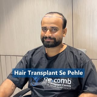 The truth about hair loss secrets you shouldn't ignore! 🤫

Before his hair transplant, our patient’