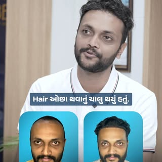 Losing your hair at just 20 years old? Don’t ignore it! 📉

Sajanbhai started losing his hair around