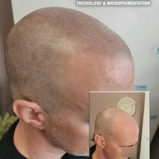 Over 10 years of experience in scalp treatment. Natural results - gain your confidence back! Find ou