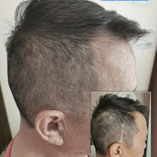 Micropigmentation - Scar camouflage
See more at thescalpcare.com
