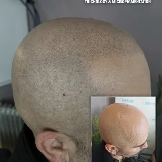 Male pattern hair loss camouflaged with scalp micropigmentation.
More @ www.thescalpcare.com