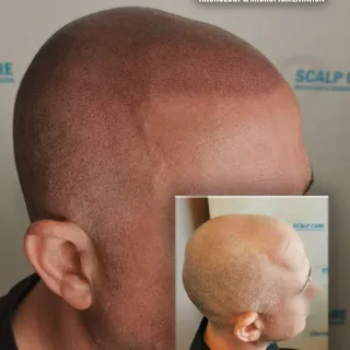 Natural looking hairline. Scalp Care Dublin, best results, 100% satisfied customers. Trust 10 years 